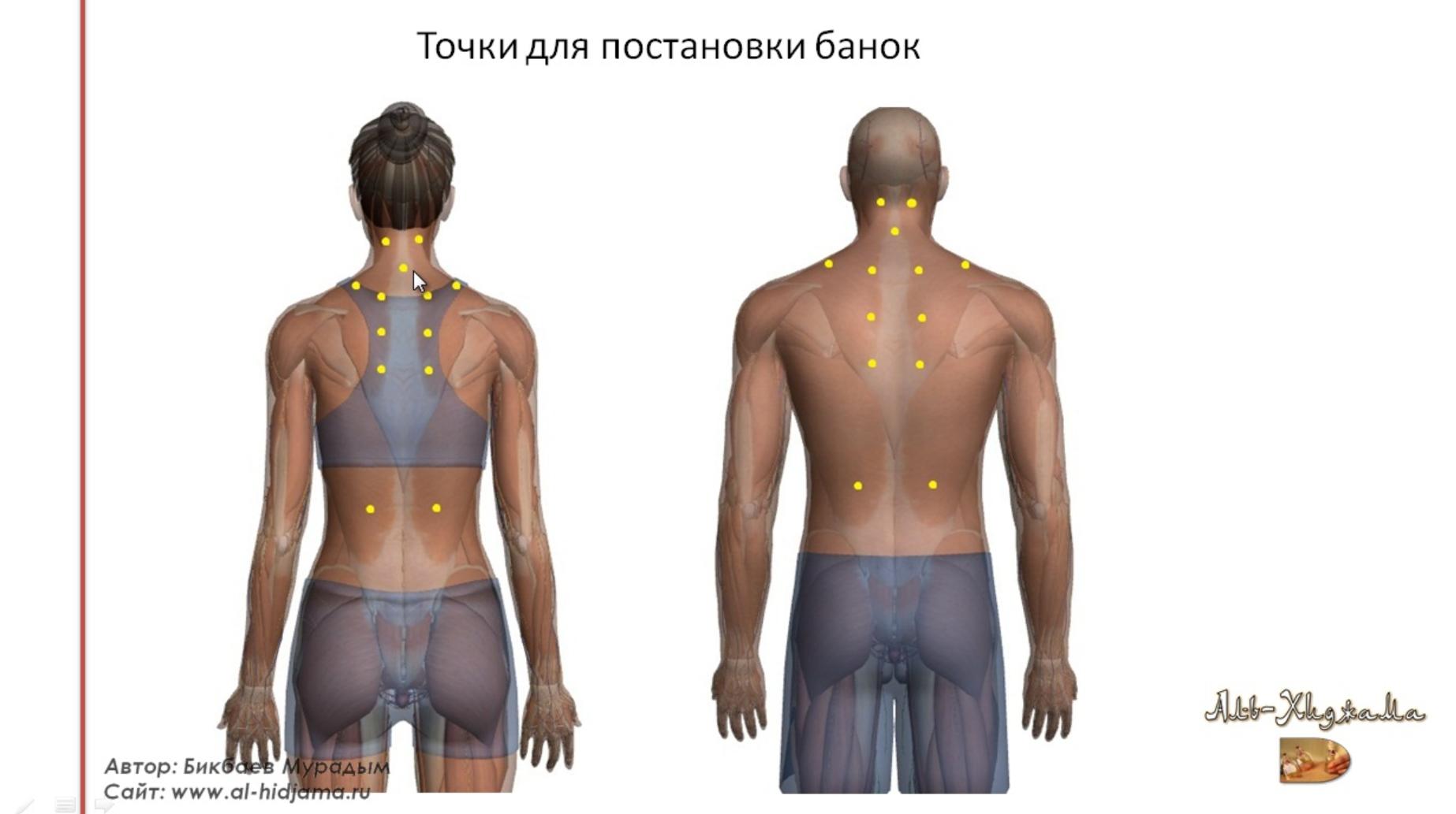 Хиджама что это